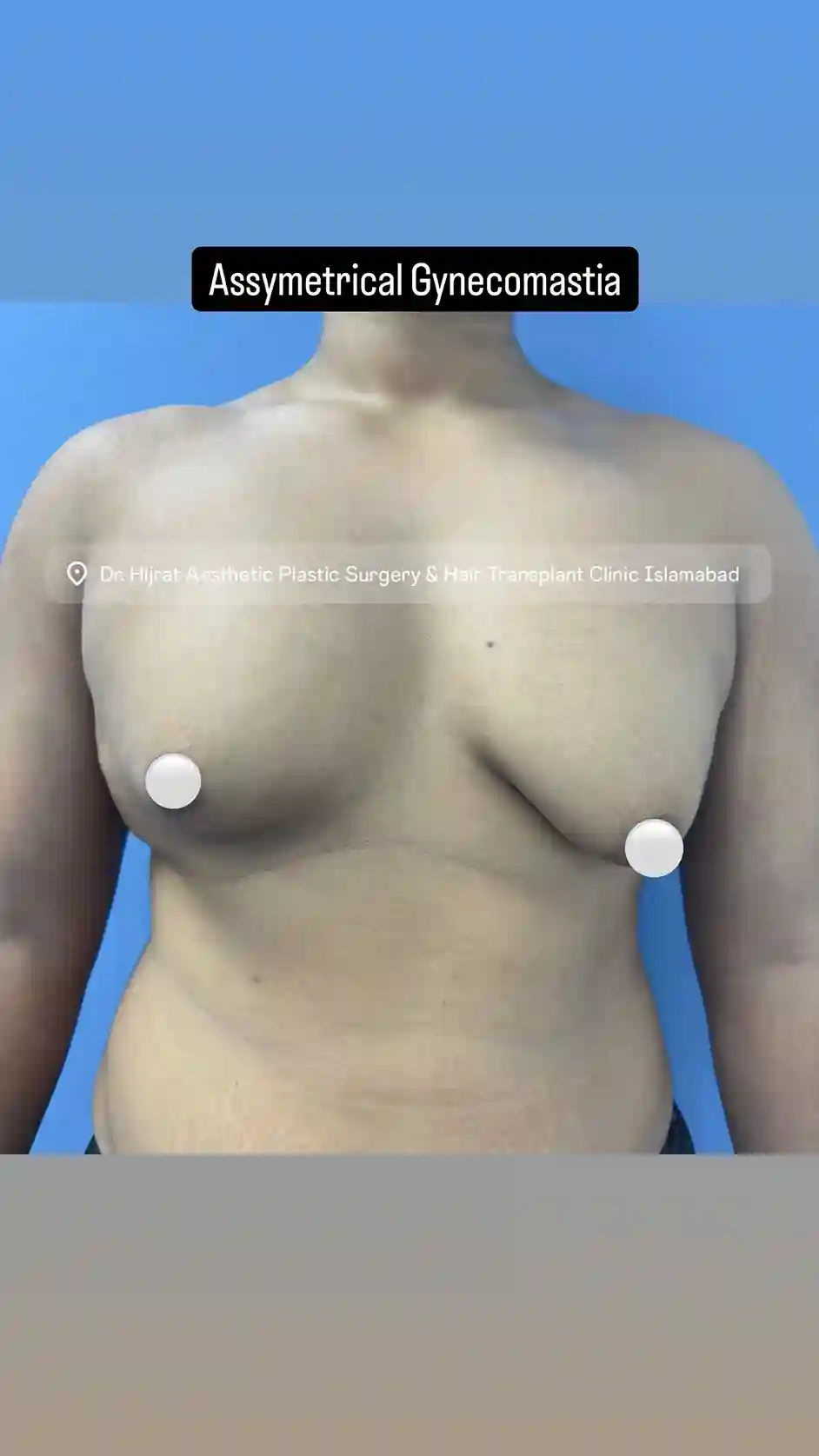 Gynecomastia Surgery